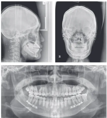 Table 1. Comparison	of	the	cephalometric	analyses	among	before,	after	first	surgery	and	re-treatment	