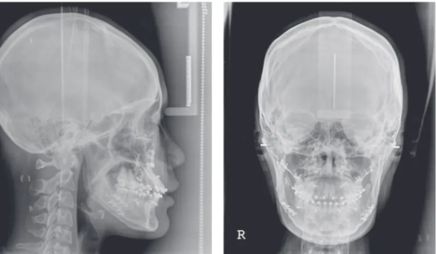 Figure 6.	Lateral	and	posteroanterior	cephalograms	and	panoramic	radiograph	one	month	after	surgery.