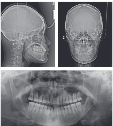 Figure 8.	Post	treatment	lateral	and	posteroanterior	cephalograms	and	panoramic	radiograph.