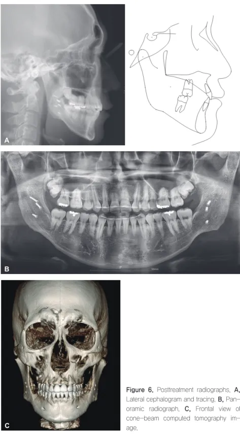 Figure  6.	 Posttreatment	 radiographs.	 A,	  Lateral	cephalogram	and	tracing.	B,	Pan-oramic	 radiograph.	 C,	 Frontal	 view	 of	 cone-beam	 computed	 tomography	  im-age.