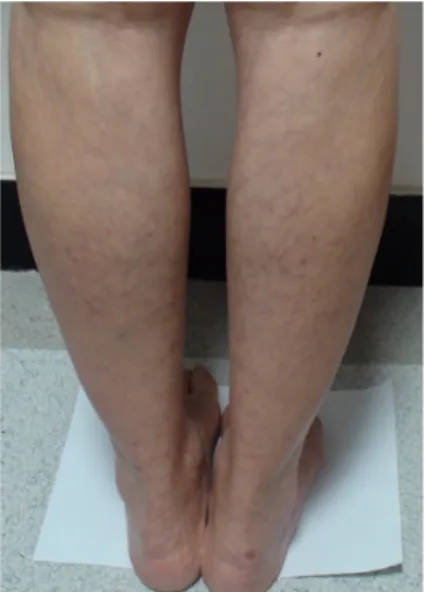 Figure 1. Photograph of both calf during prolonged standing. 