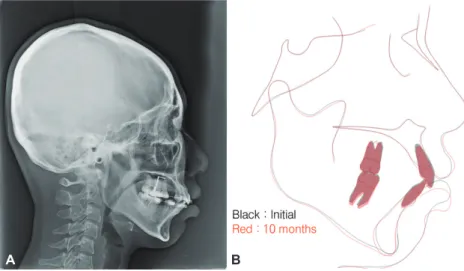 Figure 8.	Lateral	cephalogram	of	10	months	after	bracket	bonding	(A)	and	superimposition	image	with	initial	lateral	cephalogram	(B).