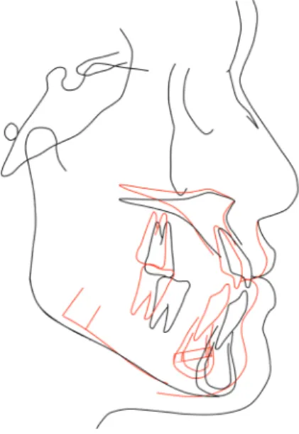 Table 2.	Orthognathic	surgery	plan Maxilla Le	Fort	I	osteotomy