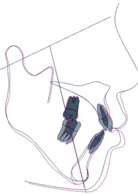 Figure 8.	Superimposition	of	cephalograms:	before	and	after	treatment.	Red	line:	before	treatment,	blue	line:	after	treatment.