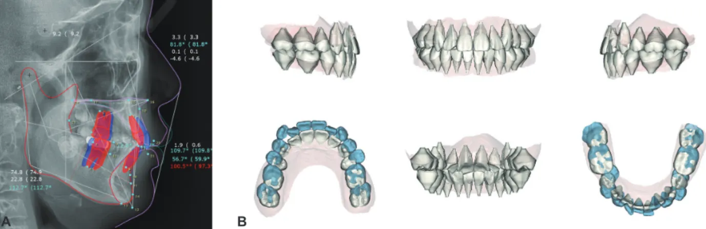 Figure 2.	Pretreatment	visual	treatment	objective	from	lateral	cephalometric	tracing	(A)	and	3D	virtual	setup	result	(B)	for	the	patient.