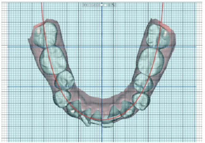 Figure 5.	Arch	form	template	arranged	to	the	predetermined	 lower	arch	midline	and	lower	incisor	AP	position.	Treatment	 plans	 were	 to	 maintain	 the	 lower	 midline,	 extract	 the	 lower	 second	premolars	for	resolution	of	crowding,	and	retract	the	 low