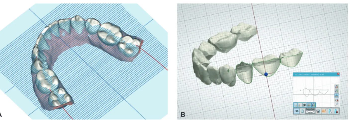 Figure 7.	The	horizontal	indicator	screen	can	help	to	identify	the	level	of	the	marginal	ridge	(A).	The	clipping	view	of	the	proximal	ar- 7.	The	horizontal	indicator	screen	can	help	to	identify	the	level	of	the	marginal	ridge	(A).	The	clipping	view	of	the	