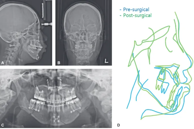 Figure 9. Post-surgical	cephalogram,	panoramic	radiograph	and	superimposition	(pre-surgical,	post-surgical).	A,	Lateral	cephalo- Post-surgical	cephalogram,	panoramic	radiograph	and	superimposition	(pre-surgical,	post-surgical).	A,	Lateral	cephalo-gram.	B,	