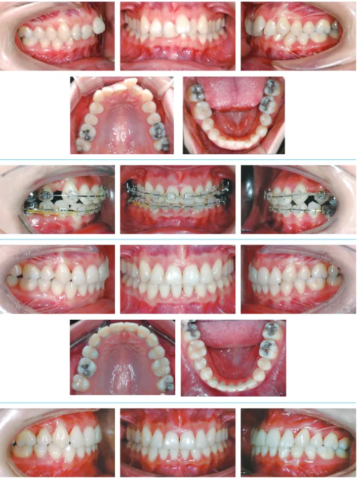 Figure 1.	An	example	of	the	lower	three	incisors	case	treatment	through	left	canine	substitution.