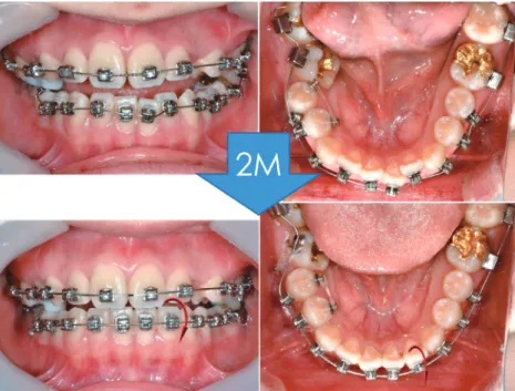 Figure 1.	During	alignment	of	lower	left	lateral	incisor,	flaring	(red	arrows)	occurred	causing	error	in	first-order	alignment	between	 left	incisor	and	canine.	Modified	from:	Kim	MS,	Lim	SH,	Jeong	SR.	Treatment	of	unilateral	scissor	bite	using	orthodontic