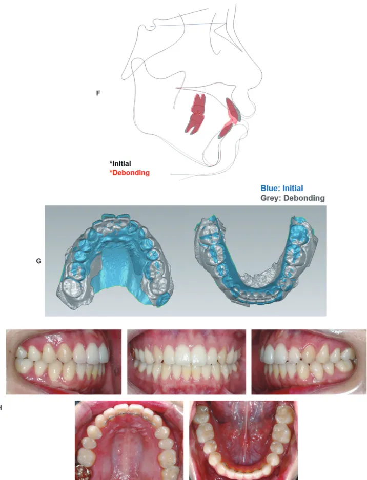 Figure  2.  (Continued)  F,  Superimposition  of  initial  and  debonding  lateral  cephalogram  X-rays