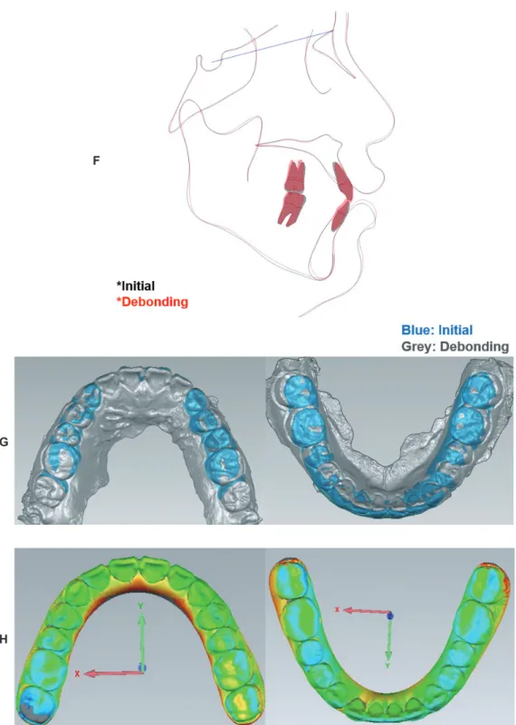 Figure  3.	 (Continued)	 F,	 Superimposition	 of	 initial	 and	 debonding	 lateral	 cephalogram	 X-rays.	 G,	 Superimposition	 of	 initial	 and	 debonding.	H,	Superimposition	of	digital	setup	and	debonding.