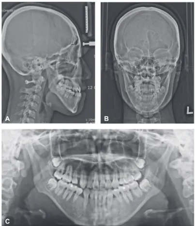 Figure 2.	Pretreatment	cephalogram	and	panoramic	radiograph.	A,	Lateral	cephalogram.	B,	PA	cephalogram.	C,	Panorama.ACB Figure 3.	Pretreatment	CBCT	images.	A,	Lower	incisors	#41	(left),	#31	(right).	B,	Lover	1st	molars.AB