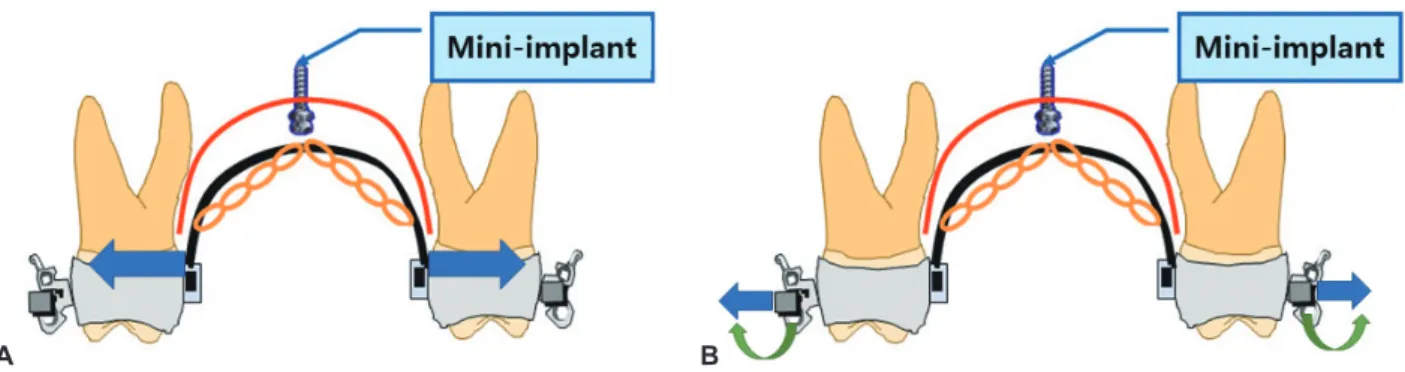 Figure 11.	Method	to	compensate	for	palatal	tipping.	A,	Expansion	of	transpalatal	arch.	B,	Expansion	or	buccal	torque	bending	of	 archwire.