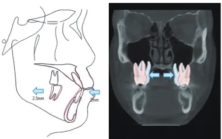 Figure 4.	Lateral	VTO	and	frontal	VTO.