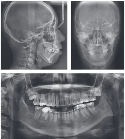 Figure 4.	Lateral,	antero-posterior	cephalograms	and	panoramic	radiographs	before	orthognathic	surgery.