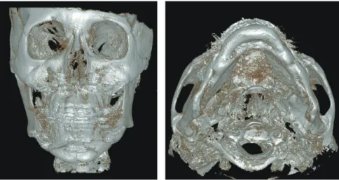 Figure 7.	CBCT	after	orthognathic	surgery.
