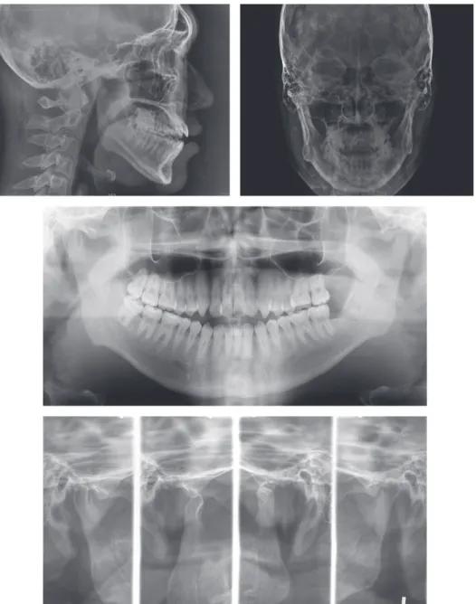 Figure 2.	Lateral	cephalogram,	frontal	cephalogram,	panoramic	radiograph	and	temporomandibular	joint	dysfunction	(TMJ)	4	view	 radiograph	of	pretreatment.	