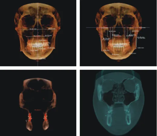 Figure 6.	Three-dimensional	computed	tomography	analysis	of	posttreatment.