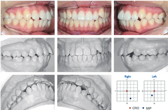 Figure 2.	Pre-treatment	intraoral	photographs	in	maximum	intercuspal	position	(MIP)	and	pre-treatment	dental	casts	mounted	in	 centric	related	occlusion	(CRO).	With	Mandible	position	indicator	(MPI)	data,	CRO-MIP	discrepancies	at	joint	level	is	visualized.