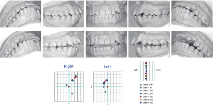 Figure 7.	Comparison	of	pre	and	post	stabilization	dental	models	mounted	in	centric	related	occlusion	(CRO).	Changes	in	mandible	 position	indicator	(MPI)	data	during	splint	therapy	shows	upward	seating	of	the	condyles	in	the	fossa	from	their	initial	posit