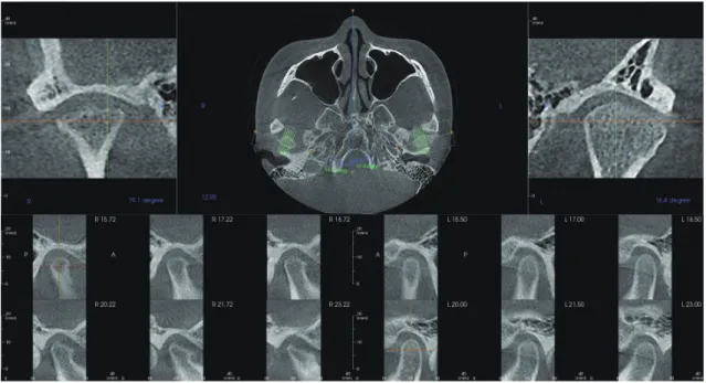 Figure 9.	Post-stabilization	cross-sectional	CBCT	images	showing	the	continuity	of	cortical	bone	of	condylar	heads.