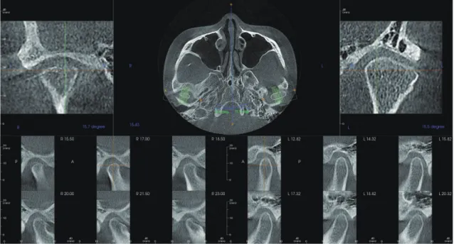 Figure  15.	 Comparison	 of	 pre	 and	 post-stabilization	 and	 post-treatment	 cephalograms.	 Cephalometric	 superimposition.	 Black:	