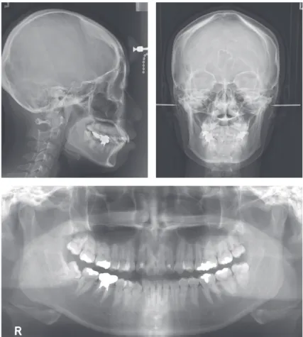 그림 2. Pretreatment lateral and frontal cephalograms and panoramic radiograph.