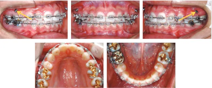 그림 3. Intraoral photographs during retraction, and direction of elastomeric modules (yellow arrows).
