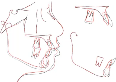 그림 7. Superimposition of the lateral and frontal cephalograms at pretreatment (black) and posttreatment (red).
