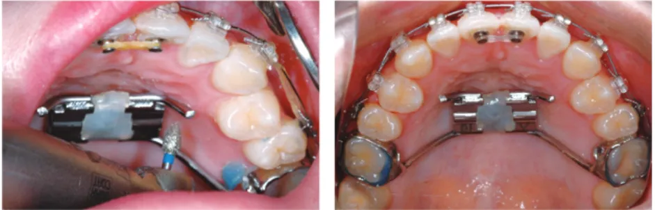 그림 9. Removal of the only premolar arms of RPE for the alignment of maxillary first premolars and using RPE as an anchor.