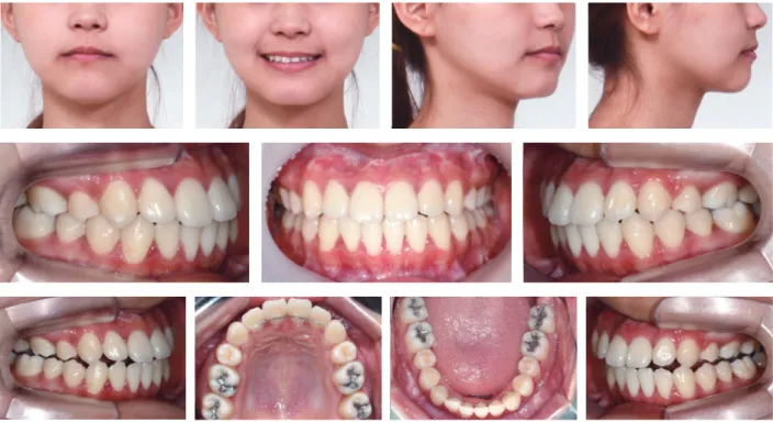 그림  11.  Treatment  progress.  A,  Initial  tooth  movement  after  upper  premolar  extraction