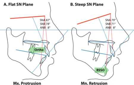 그림 1. Alteration of cephalometric determinants due to skeletal base steepness in the same morphologic patients