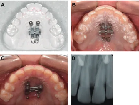그림 3.  Bone-borne RPE 장착을 위한 clear retainer 형태의 transfer zig 장착 전(A)과 후(B), RPE 40회 확장 시 구내 사진(C)과 치 근단 방사선사진(D).