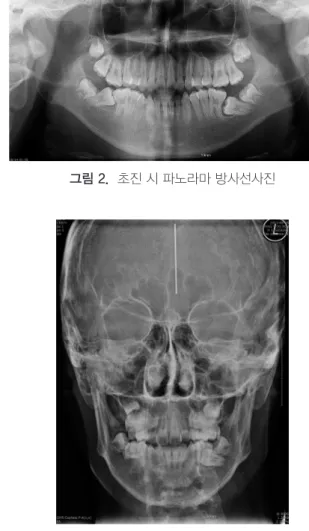 그림 2.  초진 시 파노라마 방사선사진  그림 3.  초진 시 측모두부계측방사선사진 그림 4.  초진 시 정모두부계측방사선사진의 치열 정중선이 일치하지 않았다(그림 1).초진시 파노라마 방사선사진을 보면, 양측 하악 제2대구치가 근심경사된 채 매복되어 있으며, 특히 좌측 제2대구치가 더 심한 경사도를 보이며 매복되었다