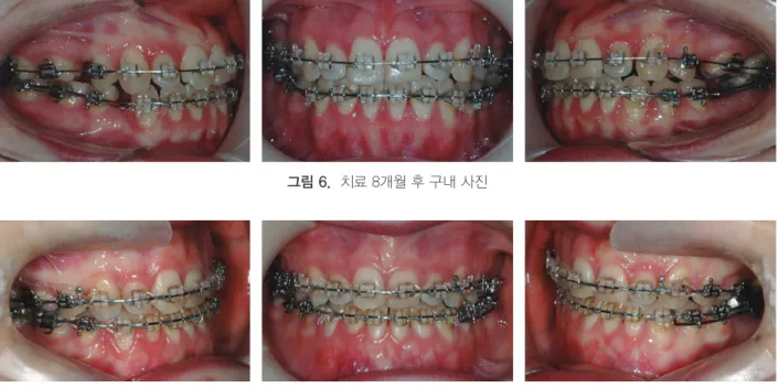 그림 6.  치료 8개월 후 구내 사진 그림 7.  치료 25개월 후 구내 사진 호선을 삽입하고 하악은 016×022 각형 NT호선을  삽입하였다. 약 5개월간 총생을 모두 해결하고 전 치부가 여전히 절단교합이어서 하악에 먼저 018× 025 각형 SS호선을 삽입하고 sliding으로 공간폐쇄 를 시작하였고 그 다음달에 상악도 019×025 각형  SS호선을 넣고 공간폐쇄를 시작하였다