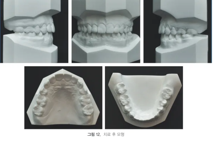 그림 12.  치료 후 모형