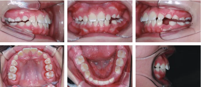 그림 14.  상악의 posterior bite block과 하악의 lingual arch를 동시에 제거한 후의 구강 내 사진. 가위교합측과 정상측 모두 구치부  개방교합을 보이고 있다