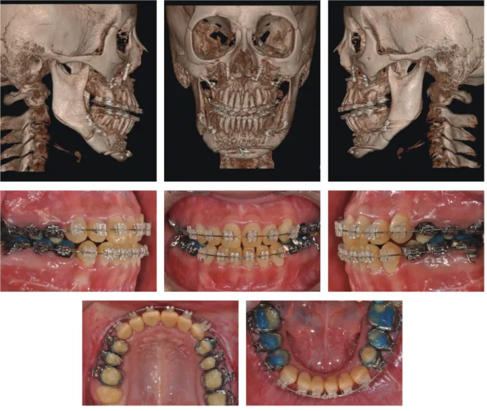 그림 8.  수술 후 2개월 CBCT 및 구내 사진.