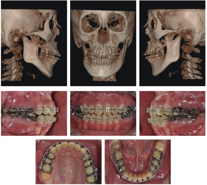 그림 5.  수술 전 CBCT 및 구내 사진술 전 교정으로 인해 상하악 전치부의 미약한 정출 및 치관 보철로 인해 임상 치관 길이가 증가하여 개방교합 양상이 개선되었고 하악 평면각의 변화는 없었다(그림 6).안면비대칭 및 골격성 II급 부정교합을 해결하기 위해 양악 수술이 시행되었다