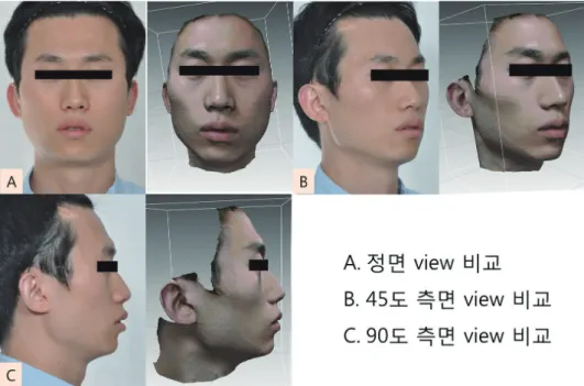 그림 13.  임상 카메라 촬영 영상과 3D scanning 영상의 비교