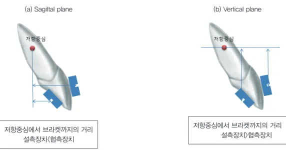 그림 11.  KILBON 장치의 구성요소(a) 전치부 splinting, (b) 구 치부 splinting, (c) guide bar, (d) path hole, (e) lever arm