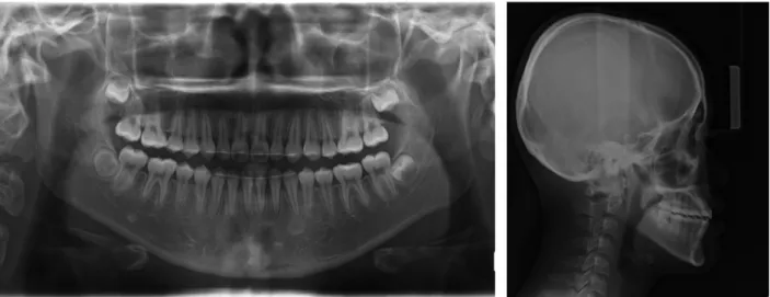 그림 11.  치료 종료시 Panorama radiograph 그림 12.  치료 종료시 Lateral cephalometry