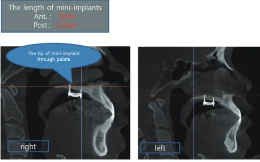 그림 1.  Bicortification되어 식립 된 mini-implants. 