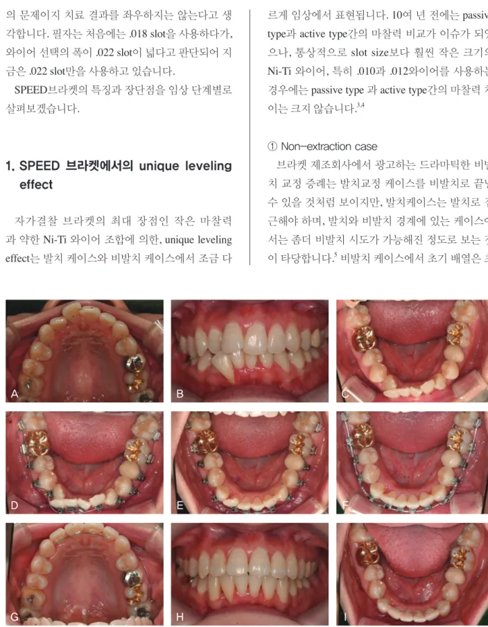 그림 1.  SPEED 브라켓 비발치 케이스. A-C,초진시 구내사진; D,하악브라켓본딩 후 .010 Cu. Ni-Ti(치료시작 10일 후); E,#42번 치 아의 브라켓 재위치 후 .010 Cu