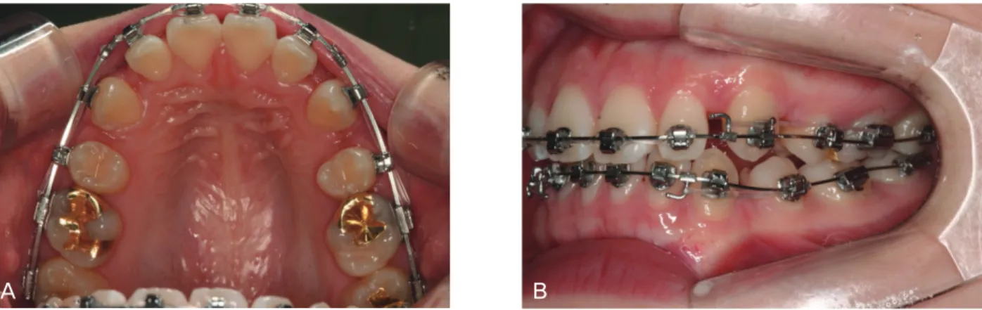 그림 5.  Bi-frictional self-ligation bracket에서 공간폐쇄. A, 6전치에는 active type self-ligation 브라켓인 SPEED 브라켓을 사용하고,  제2 소구치에는 passive type self-ligation 브라켓인 Damon브라켓을 사용하는 sliding mechanics; B, 하악에는 깊어진 전치부 수직 피개를 개선하기 위해 .016X.022 reverse curve of Spee Ni-Ti를 사용