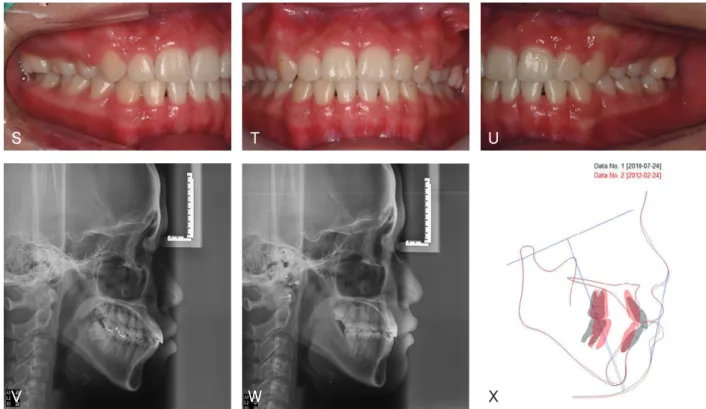 그림 6.  Bi-frictional self-ligation 브라켓에서 differential Straight-Arch concept을 적용한 공간폐쇄