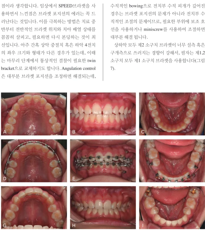 그림 7.  상하악 제2 소구치 SPEED브라켓의 심한 설측경사.A-C, 초진 구내사진; D-F, .016X.022 SS상에서 공간폐쇄(.018 slot  SPEED 브라켓 사용); G-I