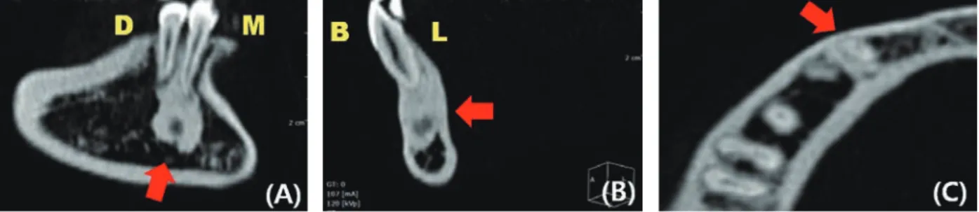 그림 3.  초진 시 Fan-beam CT 영상. (A) Sagittal View. (B) Coronal View. (C) Axial View.