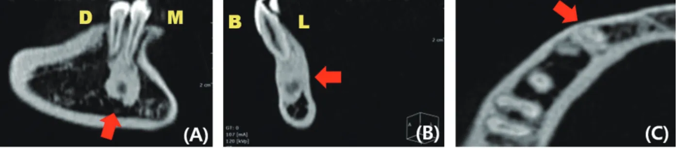 그림 3.  초진 시 Fan-beam CT 영상. (A) Sagittal View. (B) Coronal View. (C) Axial View.